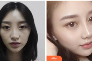 綿陽煌佳醫(yī)學(xué)美容診所曹喜蓉整形價格表附鼻部綜合案例展示