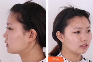 綿陽第三人民醫(yī)院醫(yī)療美容科陳芳整形價格表附鼻部綜合案例展示