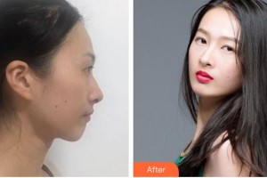 綿陽第三人民醫(yī)院醫(yī)療美容科廖小川整形價格表附鼻部綜合案例展示