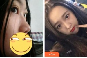 綿陽協(xié)和醫(yī)院醫(yī)學(xué)美容中心孟春麗整形價格表附肋軟骨隆鼻案例展示