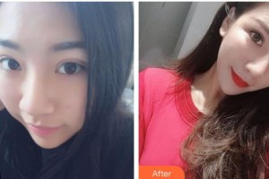 綿陽整形美容醫(yī)院王步禮整形價格表附鼻部綜合案例展示