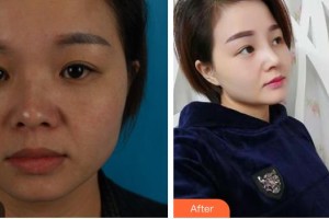 綿陽整形美容醫(yī)院趙波整形價格表附耳軟骨復(fù)合隆鼻案例展示
