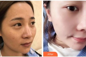 綿陽中心醫(yī)院醫(yī)學(xué)美容科周竹梅整形價格表附鼻部綜合案例展示