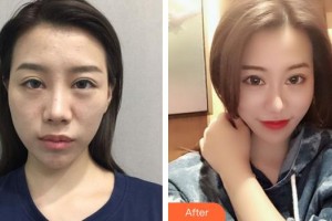 綿陽中心醫(yī)院醫(yī)學(xué)美容科周平武整形價格表附鼻部綜合案例展示