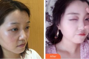 綿陽中心醫(yī)院醫(yī)學(xué)美容科趙平武整形價格表附鼻部綜合案例展示