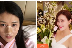 綿陽中心醫(yī)院醫(yī)學(xué)美容科杜永忠整形價格表附鼻部綜合案例展示