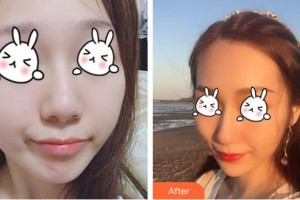 綿陽中心醫(yī)院醫(yī)學(xué)美容科劉小意整形價格表附無針水光案例展示