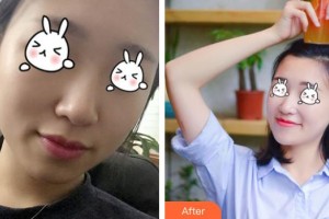 綿陽整形美容醫(yī)院任林森整形價格表附無針水光案例展示