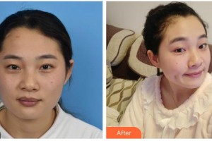 綿陽口腔醫(yī)院整形美容科彭澤勛整形價格表附光子嫩膚案例展示