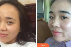 綿陽茗匯醫(yī)療美容醫(yī)院吳承勇整形價格表附光子嫩膚案例展示