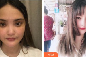 綿陽東美奧拉克醫(yī)療美容門診部盧元剛整形價格表附耳軟骨復(fù)合隆鼻案例展示