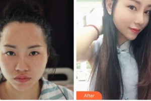 綿陽韓美醫(yī)療整形美容診所彭太平整形價(jià)格表附肋軟骨隆鼻案例展示