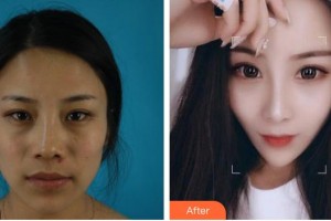 綿陽東美奧拉克醫(yī)療美容門診部鄒佳整形價(jià)格表附肋軟骨隆鼻案例展示