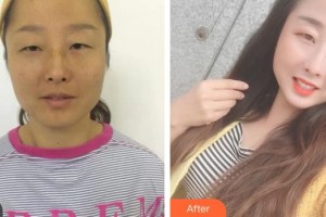 綿陽愛爾眼科醫(yī)院周晶蓉整形價(jià)格表附內(nèi)切祛眼袋案例展示