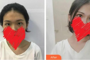 綿陽愛爾眼科醫(yī)院楊智整形價(jià)格表附切開雙眼皮案例展示