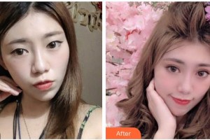 廣元美華醫(yī)學(xué)美容診所楊林整形價(jià)格表附眼部綜合案例展示