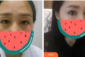 廣元美立方醫(yī)療美容醫(yī)院李民臣整形價(jià)格表附切開雙眼皮案例展示