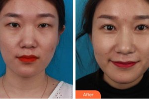 廣元市利州區(qū)中醫(yī)醫(yī)院眼科李圣住院醫(yī)師整形價(jià)格表附切開雙眼皮案例展示