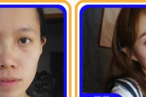 廣元市第三人民醫(yī)院眼科胡開東整形價(jià)格表附眼部綜合案例展示