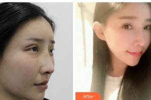 廣元市中心醫(yī)院眼科王軍整形價格表附切開雙眼皮案例展示