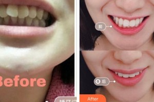 廣元口腔醫(yī)院張孝華整形價格表附牙齒隱形矯正案例展示