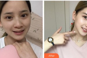 遂寧市中心醫(yī)院燒傷整形科羅長生整形價格表附鼻部綜合案例展示