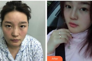 遂寧市中心醫(yī)院燒傷整形科王國昌整形價格表附鼻部手術(shù)案例展示