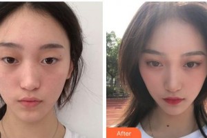 遂寧伊莎貝拉醫(yī)學美容門診部羅華整形價格表附眼部綜合案例展示