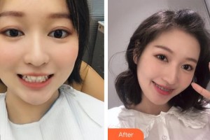 遂寧嘉慧口腔門診部胡婷婷整形價格表附金屬托槽矯正案例展示