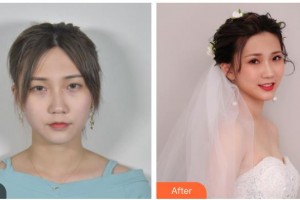 內(nèi)江市中醫(yī)醫(yī)院百合醫(yī)學(xué)美容中心薛明整形價格表附眼部綜合案例展示