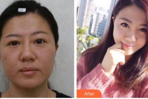 內(nèi)江市中醫(yī)醫(yī)院百合醫(yī)學(xué)美容中心張艷鋒整形價格表附埋線雙眼皮案例展示