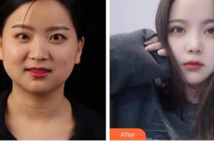 內(nèi)江市中醫(yī)醫(yī)院百合醫(yī)學(xué)美容中心蘭潔整形價格表附眼部綜合案例展示