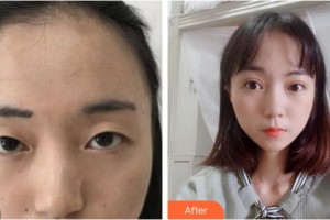 內(nèi)江市中醫(yī)醫(yī)院百合醫(yī)學(xué)美容中心李相君整形價格表附切開雙眼皮案例展示