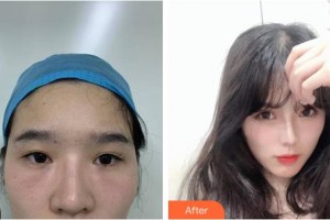 內(nèi)江百齡京菊醫(yī)療美容門診部龍卓宏整形價格表附眼部修復(fù)案例展示