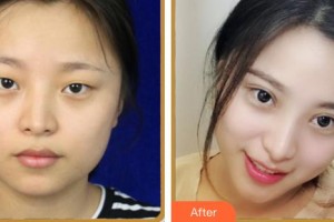 內(nèi)江百齡京菊醫(yī)療美容門診部徐勇整形價格表附眼部綜合案例展示