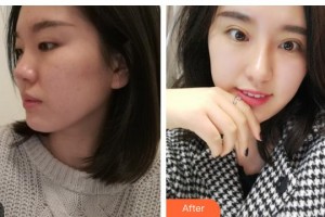 內(nèi)江百齡京菊醫(yī)療美容門診部劉培整形價格表附眼部綜合案例展示