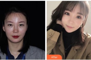 內(nèi)江百齡京菊醫(yī)療美容門診部李果整形價格表附眼部綜合案例展示