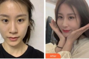 內(nèi)江百齡京菊醫(yī)療美容門診部文斌整形價格表附切開雙眼皮案例展示