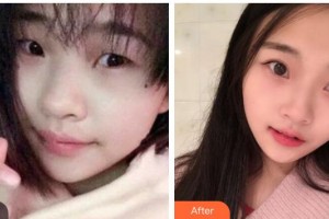 內(nèi)江百齡京菊醫(yī)療美容門診部謝肇菊整形價格表附切開雙眼皮案例展示