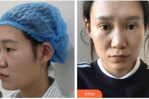 內(nèi)江瑞美醫(yī)療美容門診部楊娟整形價格表附眼部綜合案例展示