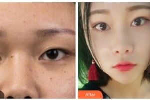 內(nèi)江瑞美醫(yī)療美容門診部羅冬鈴整形價格表附切開雙眼皮案例展示