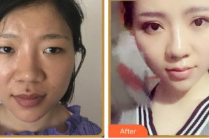 內(nèi)江洋子醫(yī)療美容診所羊一華整形價格表附眼部綜合案例展示