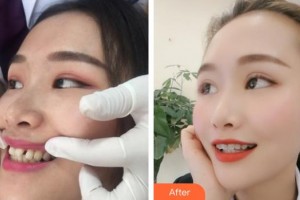 內(nèi)江華美口腔醫(yī)院代季佩整形價格表附隱形托槽矯正案例展示