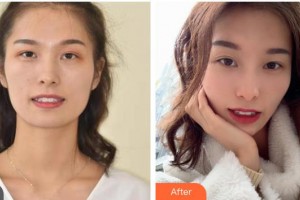 內(nèi)江華美口腔醫(yī)院剛整形價格表附牙齒隱形矯正案例展示