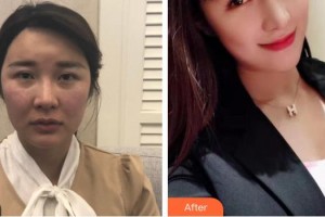 樂山金手指醫(yī)學(xué)美容診所方名整形價格表附肋軟骨隆鼻案例展示