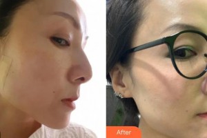 樂山金手指醫(yī)學(xué)美容診所羅秀平整形價格表附埋線提升案例展示