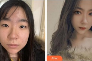 樂山天姿醫(yī)療美容診所楊劍軍整形價格表附埋線雙眼皮案例展示