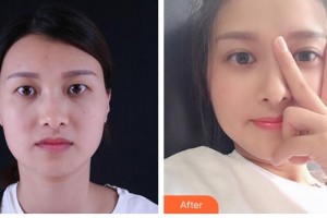 樂山美銳整形美容診所侯鵬整形價格表附眼部整形案例展示