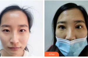 樂山美銳整形美容診所謝斌冰整形價格表附眼部綜合案例展示