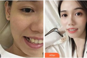 樂山英美口腔診所孫玉萍整形價格表附金屬托槽矯正案例展示